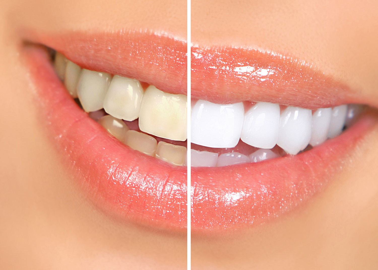 tooth-whitening nu smile dental dentist eastern cape